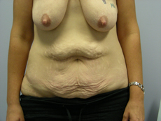 woman body with excess skin, Tummy Tuck, Scottsdale AZ
